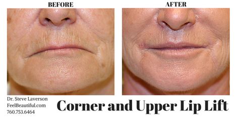 Corner and Upper Lip Lift. Rejuvenate your facial harmony and get a more pleasant appearance. 760.753.6464 Corner Lip Lift, Lip Lift Surgery, Upper Lip Lift, Facial Harmony, Lip Lift, Upper Lip, Feel Beautiful, Plastic Surgery, How To Feel Beautiful