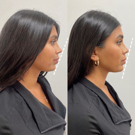 Jawline Surgery, Facial Contouring Fillers, Thick Skin Rhinoplasty, Facial Balancing, Facial Balancing Before And After, Soft Jawline, Chin Fillers Before After Round Face, Face Balancing Fillers, Profile Balancing Fillers