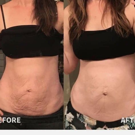 Sagging Belly, Mom Bod, Post Baby Body, Firm Skin, Firming Cream, Loose Skin, Sagging Skin, Skin Firming, Diet