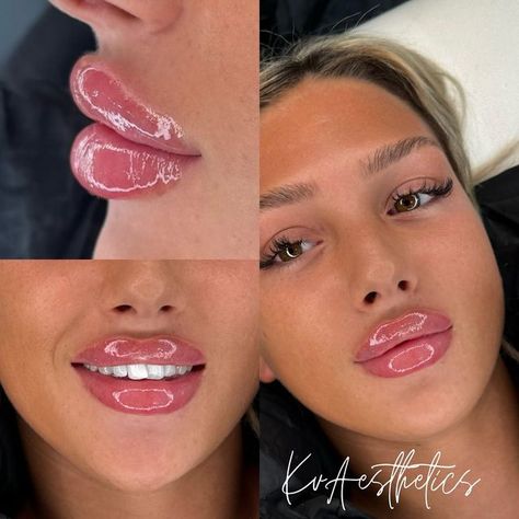 Katherine Victoria on Instagram: "Bratz Doll Lips 💋  @caitlinsherwoodx   This Is Your Sign 💫 1ml Refresh 💞  Sunderland Aesthetics @kvaestheticsuk   Get booked In This Week 📲  Refresh Starting From £100   ✨✨✨Thank you EVERYONE for spreading your positive vibes out there. ✨✨✨" Bratz Lip Filler, Bratz Doll Lip Filler, Doll Lips Filler, Bratz Doll Lips, Bratz Lips, 1ml Lip Filler, Doll Lips, Lip Filler, Lip Fillers