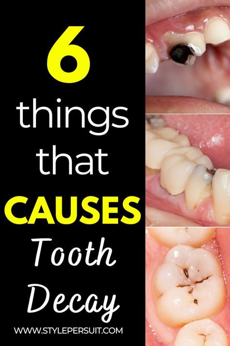 Tooth decay, also known as dental caries or cavities, is a common dental issue that occurs when bacteria in your mouth produce acids that erode the enamel of your teeth. If left untreated, tooth decay can lead to pain, infection, and even tooth loss. Understanding the symptoms and causes of tooth decay is essential for maintaining good oral health. Here's what you need to know. Tooth Infection, Tooth Cavity, Dental Decay, Ways To Heal, Teeth Health, Receding Gums, Tooth Decay, Oral Hygiene, Dental Health