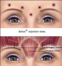 Botox For Headaches, Botox Migraine, Botox Injection Sites, Injection Sites, Botox Training, Botox Injection, Botox Brow Lift, Eyebrow Lift, Botox Alternative