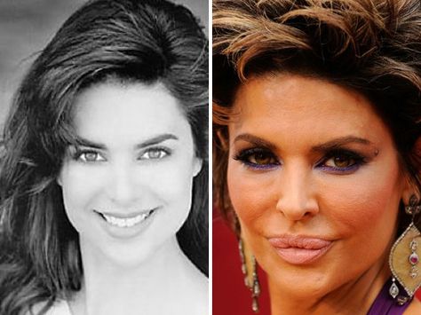 Lisa Rinna before & after + a number of years Bad Celebrity Plastic Surgery, Botched Plastic Surgery, Bad Plastic Surgeries, Plastic Surgery Fail, Plastic Surgery Photos, Plastic Surgery Gone Wrong, Plastic Surgery Procedures, Mickey Rourke, Celebrity Plastic Surgery