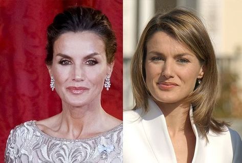 Letizia d’Espagne est-elle accro à la chirurgie esthétique ? L’apparence de l’ancienne journaliste a beaucoup évolué depuis son entrée dans la famille royale. La reine aurait subi de nombreuses opérations qui ont modifié son visage. Royals, Stars