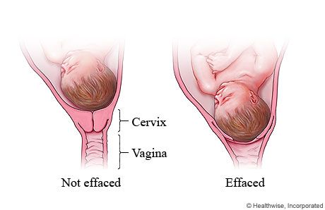 #4- Another view of Effacement Pregnant Anatomy, Cervical Effacement, Dilation And Effacement, Birth Classes, Cervical Dilation, Signs Of Labor, False Labor, Midwifery Student, Medical Illustrations