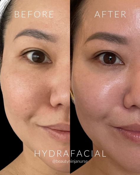 Hydrafacial Magic 🪄 Before ➡️ After: The proof is in the glow! ✨💖 Hydrafacials are the ultimate skin treat, delivering deep hydration and a luminous complexion. They cleanse, exfoliate, and hydrate, leaving your skin radiant and refreshed. Perfect for any occasion or just because! 💧✨ It’s time to say goodbye to dullness and hello to a radiant, refreshed complexion! 🌟 Book your Hydrafacial at Artistry Wellness Hawaii and get that glow! 🌺 👉 Artistry Wellness Hawaii 📲📞 808-452-0452 📍 850 W. Hi... Hydrafacial Before And After, To Say Goodbye, Med Spa, The Glow, Say Goodbye, Honolulu, Just Because, Beauty Skin, Hawaii