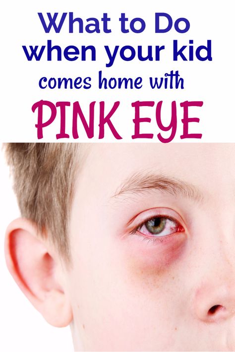 What to do when your kid has pink eye - what to do when your kid comes home with conjunctivitis- homeopathic remedy for pinkeye- homeopathic remedy for conjunctivitis #Sponsored #womenschoiceawards #homemopathic #pinkeye Pink Eye Remedy For Kids, Pink Eye Remedy, Treating Pink Eye, Pink Eye Home Remedies, Detox For Kids, Natural Pink Eye Remedy, Pinkeye Remedies, Constipation Remedies, Colon Cleansing