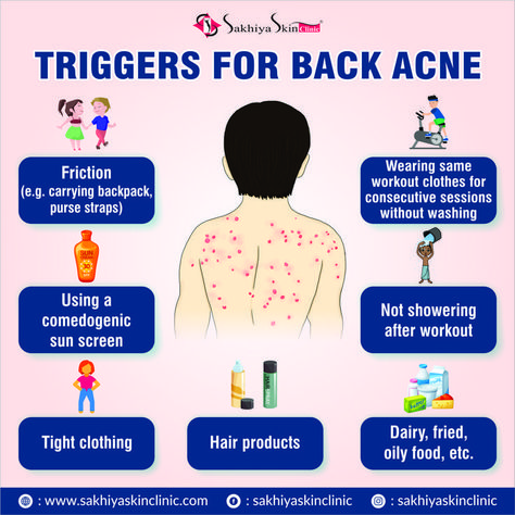 Back Acne Scar Removal, Acne Location Meaning, Acne On Back, Back Acne Causes, Back Acne Remedies, Skin Recipes, Blind Pimple, Best Laser Hair Removal, Skin Care For Acne