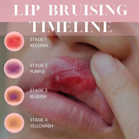 After getting lip filler, you may be surprised by the level of swelling, bruising, and tenderness you are left with. You’ve probably wondered how long does does the lip filler bruising last?

Everyone heals differently and this is down to their own anatomy, typically if our clients experience bruising this is the common time frame that it lasts for: 
Stage 1 Reddish - Immediately after treatment
Stage 2 Purple - 2-3 days
Stage 3 Blueish - 5-7 days
Stage 4 Yellowish - 1 - 2 weeks

Speak to us imm Facial Fillers, Lip Augmentation, Lip Filler, Lip Injections, Black Lips, Lip Fillers, Natural Lips, The Common, Anatomy