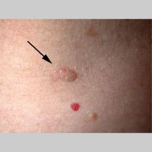 Seborrheic keratosis is a fairly common skin lesion that is characterized by hyperpigmentation in the epidermal layer of the skin taking birth in keratinocytes and appearing as slightly raised flat toped bumps. No cause is yet determined but genetic predisposition is observed...... https://naturalcureproducts.wordpress.com/2014/10/03/seborrheic-keratosis-a-benign-skin-lesion/ Skin Lesions Pictures, Basel Cell Carcinoma Pictures, Seborrheic Keratosis, Skin Lesions, Goldendoodle Grooming, Squamous Cell, Medical Coder, Skin Moles, Skin Growths