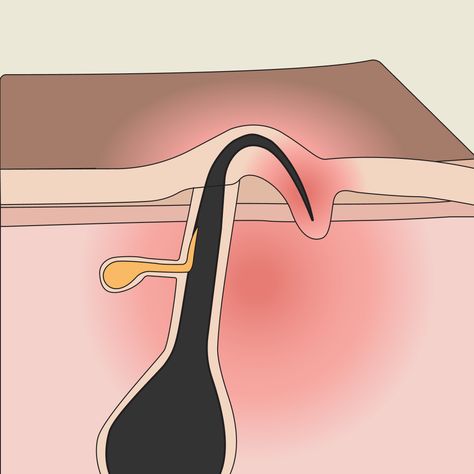 Banish the discomfort of ingrown hairs with our step-by-step guide to effectively remove ingrown hairs and prevent them from returning. How To Get Rid Of Hair Bumps, How To Get Rid Of Ingrown Hairs, Ingrown Eyebrow Hair, Shaving Alternatives, Get Rid Of Ingrown Hairs, Treat Ingrown Hair, Ingrown Hair Remedies, Bump Hairstyles, Ingrown Hair Removal