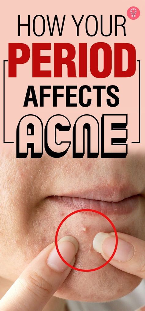 How Your Period Affects Acne Check more at https://wavefitnessstyle.com/?p=2775 Period Acne Remedies, Period Breakouts, Period Acne, Period Pimples, Peroxide For Acne, Period Health, Pimple Solution, The Menstrual Cycle, How To Reduce Pimples