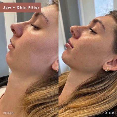 Jaw + Chin Filler | Before and After Small Lips With Filler, Small Jawline Faces, Types Of Jawlines Women, Jaw And Chin Filler Before And After, Jawline And Chin Filler, Jaw And Chin Filler, No Jawline Women, Chin Fillers Before After Round Face, Strong Jawline Women