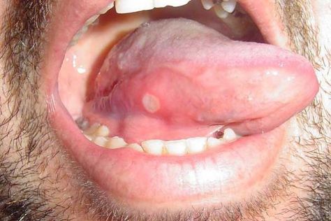 15 Common Tongue Diseases That Can Affect You Tongue Ulcer Remedies, Blister On Tongue, Canker Sore On Tongue, Throat Ulcers, Ulcer On Tongue, Tongue Problems, Mouth Blisters, Ulcer Remedies Mouth, Canker Sore Remedy