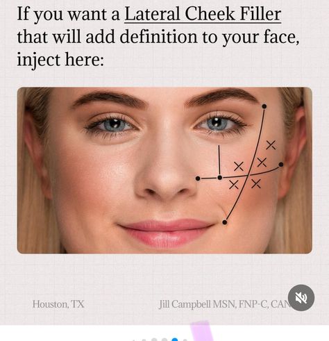 Natural Cheek Filler, Medspa Office, Cheek Injections, Botox Migraine, Face Plastic Surgery, Facial Injections, Esthetician Inspiration, Skin Anatomy, Aesthetic Nurse