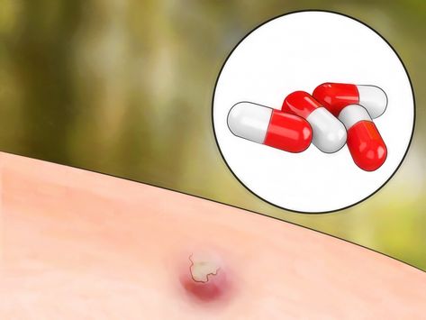 How to Get Rid of Bug Bites. All types of bugs bite — mosquitoes, black flies, horse flies, fleas, mites, chiggers, bedbugs, ticks, etc. — and not a single one of them is any fun. While the bite or sting itself may not be too bad, the swe... Black Fly Bites, Types Of Bug Bites, Bad Bugs, Hydrocortisone Cream, Types Of Bugs, Black Fly, Bug Zapper, Horse Fly, Mosquito Bite