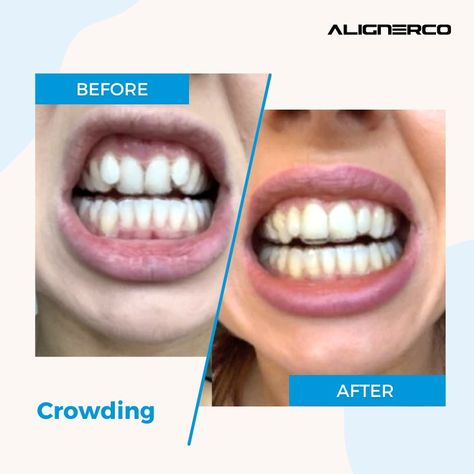 From Crooked to Confident: Witness the Amazing Aligner Transformation! Visit the link https://bit.ly/3KzGDLZ and get your smile journey started! . . #Alignerco #aligners #clearaligners #invisiblealigners #perfectteeth #smiletransformation #teeth #beforeafter #beforeandafter #beforevsafter #beforeafterteeth Clear Aligners, Perfect Teeth