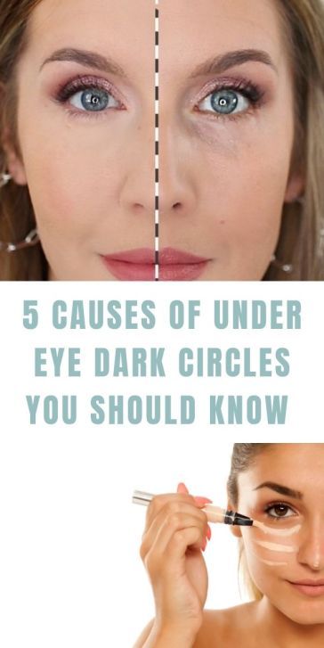 5 Causes of Under Eye Dark Circles You Should Know PLUS A Quick Concealer Hack Concealing Dark Circles Under Eyes, How To Conceal Dark Circles Under Eyes, Purple Under Eye Circles, Cover Up Dark Circles Under Eyes, How To Prevent Dark Circles Under Eyes, Dark Under Eye Circles Makeup, Dark Rings Under Eyes, Conceal Dark Under Eye Circles, Deep Set Eyes Concealer