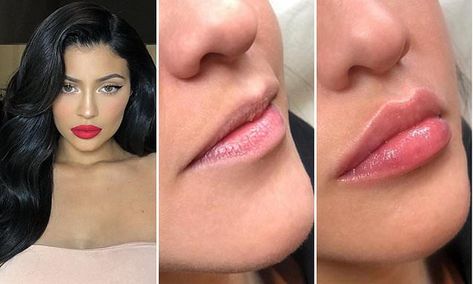 Lip 'threading' is the trend tipped to take over fillers Lip Threading, Dermal Fillers Lips, Lip Outline, Best Contouring Products, Anti Wrinkle Injections, Kylie Jenner Lips, Thread Lift, Facial Fillers, Facial Aesthetics