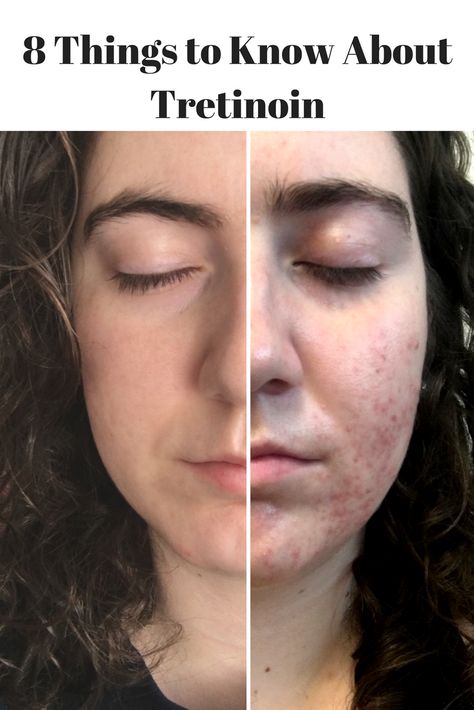 Tretinoin Before And After Wrinkles, Tretinoin Before And After Anti Aging, Retin A Before And After, Tretinoin Before And After Acne, Tretinoin Acne, Hacks For Clear Skin, Skin Treatments For Dark Spots, Tretinoin Before And After, Retinol For Beginners