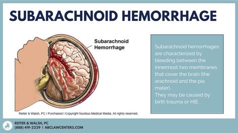 A subarachnoid hemorrhage is one of the most common types of intracranial hemorrhages (brain bleeds) in babies. Learn more here: Subchorionic Hemorrhage, Brain Bleed, Intracranial Hemorrhage, Subarachnoid Hemorrhage, Geometry Problems, English Posters, Writing Anchor Charts, Elementary Writing, Medical Medium