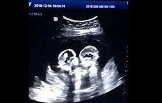 Twins Ultrasound, Identical Twins, Twin Babies, Twin Sisters, Ultrasound, Twins