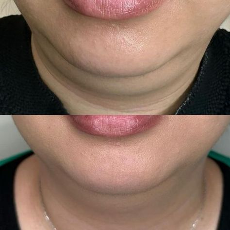 Fat Dissolving Injections, Armpit Fat, Thigh Fat, Double Chin, Stubborn Fat, Eat Well, Good Health, Cosmetology, Eating Well