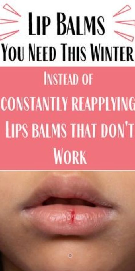 Dry Lips Remedy Overnight How To Get Rid, How To Get Rid Of Chapped Lips, Diy Lip Mask Overnight, How To Get Rid Of Dry Lips, Dry Lips Remedy Overnight, Cut On Lip, Get Rid Of Dry Lips, Dry Lips Remedy, Chapped Lips Remedy