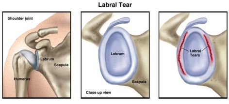 Labral Tear Shoulder, Shoulder Blade Muscles, Torn Labrum, Shoulder Dislocation, Bicep Muscle, Home Exercise Program, Shoulder Injuries, Shoulder Muscles, Improve Flexibility