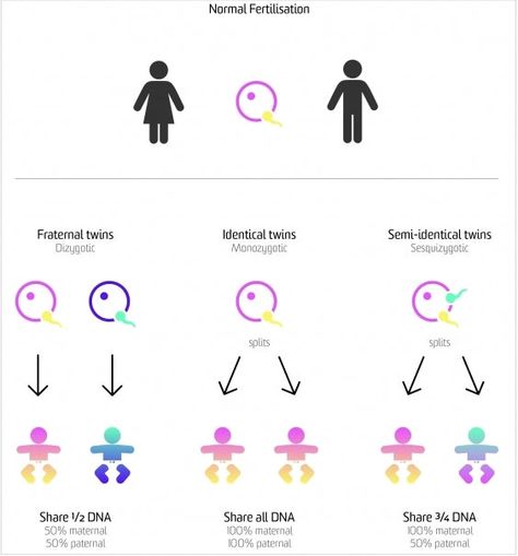 A diagram illustrating the different types of twins Types Of Twins, Development Milestones, Dna Genealogy, Fraternal Twins, Expecting Twins, Pregnancy Information, Human Anatomy And Physiology, Medicine Journal, Smart Parenting