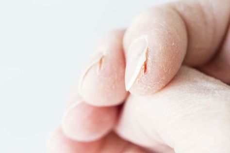 Skin Fissures and Split Fingertips #skincare #dermatology #dryskin Cracked Fingertips, Cracked Fingers, Extremely Dry Hands, Dry Cracked Hands, Cracked Hands, Nail Pictures, Cracked Skin, Skin Remedies, Skin Healing