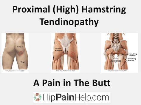 Sore Hamstrings Relief, Hamstring Tendinopathy Exercise, Sore Glutes Relief, Recovery Exercises, Sciatica Symptoms, Rotator Cuff Tear, Hamstring Muscles, Hip Pain Relief, Ligament Tear