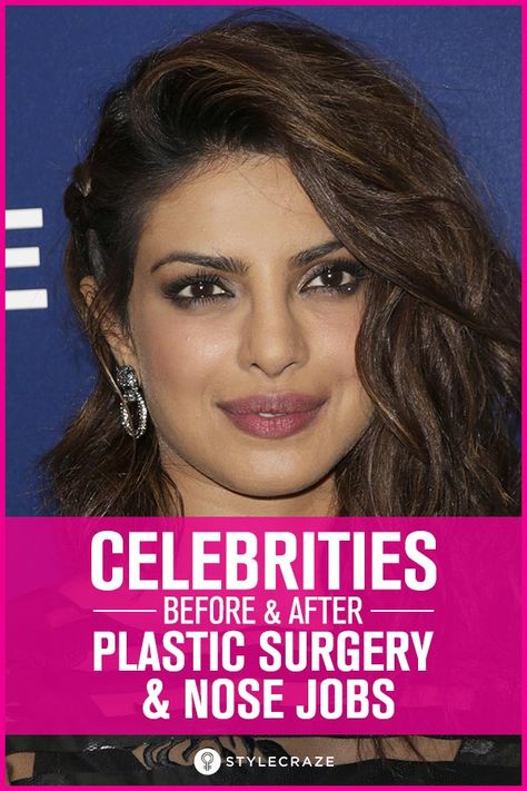 Top 25 Celebrities Before And After Plastic Surgery And Nose Jobs Celebrity Before And After Surgery, Celebrity Plastic Surgery Before After, Make Up Before And After, Blephoraplasty Before And After, Meghan Markle Nose Job, Natural Nose Job, Kris Jenner Plastic Surgery, Celebrity Nose Jobs, Bad Nose Jobs