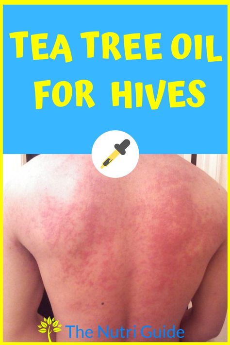 Essential Oil For Hives, Hives Remedies, Tea Tree Oil Uses, Diy Essential Oil Recipes, Essential Oil Remedy, Oil Remedies, Women Health, Young Living Oils, Exercise Tips