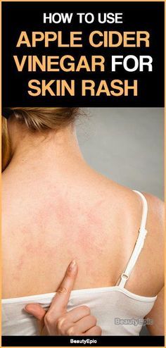 Skin Rash Remedies, Home Remedies For Rashes, Home Remedies For Face, Body Rash, Skin Blisters, Armpit Rash, Rashes Remedies, Apple Cider Vinegar For Skin, Apple Cider Vinegar Benefits