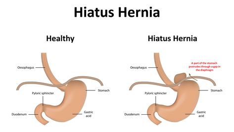 Causes and Symptoms of Esophagitis – GI Endoscopy Practice NJ – GI Endoscopy Practice Hernias In Women, Loose Connective Tissue, Bariatric Surgeon, Sick Remedies, Reflux Disease, General Surgery, Acupuncture Points, Abdominal Pain, Facts About