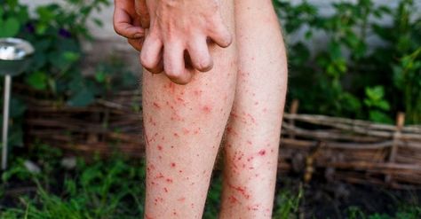 Skin Rashes Caused By Crohn’s Disease | MyCrohnsandColitisTeam Irritable Bowel Disease, Rash Causes, Bug Bite, Skin Rashes, Canker Sore, Cold Sore, Skin Disorders, Skin Conditions, Home Remedies