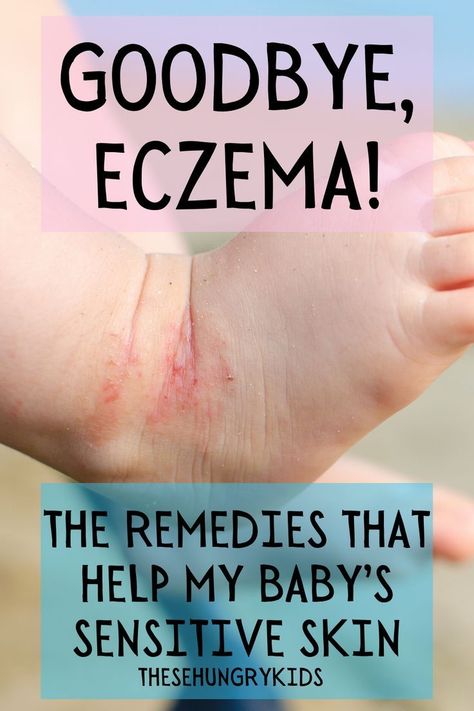 Baby Excema, Lotion Diy, Baby Dry Skin, Dry Skin Remedies, Dry Itchy Skin, Baby Advice, Skin Remedies, Baby Care, Sensitive Skin