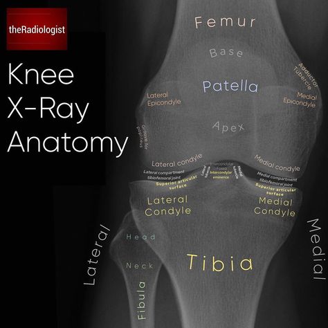 The Radiologist on Instagram: “Read on for a system I use when looking at an AP knee X-Ray…⁣ ⁣ THE AP KNEE X-RAY⁣ 👨🏽‍💻As always no assessment is complete without looking…” Medical Radiography, Radiologic Technology, Radiology Student, Radiology Technician, Radiology Imaging, Radiology Technologist, Medical Facts, Human Anatomy And Physiology, Medical Imaging