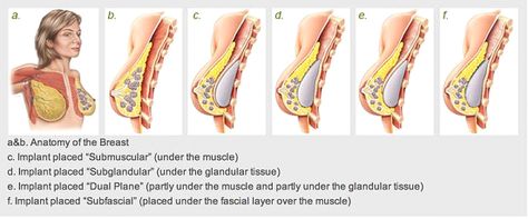 Breast Augmentation Breast augmentation (also known as augmentation mammoplasty) is a surgical procedure that can enhance your appearance.  Plastic surgeons like Dr. Javad Sajan use breast implants or a fat transfer breast augmentation procedure to increase and redefine your natural breast shape and size.    Self-Image, Nature  The shape, volume, and balance of your breasts Arm Strength, Fat Transfer, Breast Surgery, Image Nature, Executive Summary, Breast Augmentation, Plastic Surgeon, Cosmetic Surgery, Plastic Surgery