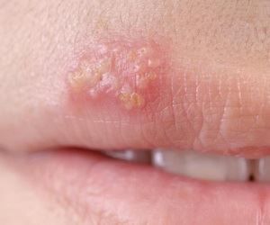 Herpes Breakthrough Leaves Doctors Speechless Fever Blister Remedy, Blister Remedies, Home Remedies For Fever, Get Rid Of Cold, Fever Blister, Cold Sores, Canker Sore, Cold Sores Remedies, Cold Home Remedies