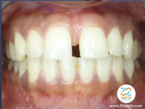 How to close gap in front teeth, teeth gap treatment, how to close gaps in teeth, Big Gaps In Teeth, Front Tooth Gap, How To Close Gap In Teeth, Gap In Front Teeth, Teeth Gap Filling, Gap In Teeth, Gaps In Teeth, Gap Between Teeth, Teeth Gap