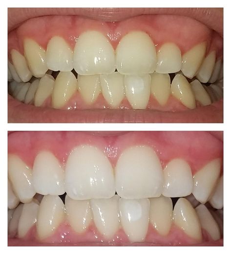 Do Crest Whitestrips Supreme work? [Before & After Images] Crest White Strips, Teeth Whitening Methods, Whitening Strips, Whitening Teeth, Best Teeth Whitening, Smile Makeover, Remove Stains, Your Smile, Oral Hygiene