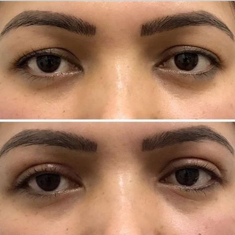 Blepharoplasty also known as upper eye lid surgery by @drrezahmadii is not just for older people, but younger people can also undergo this procedure to open the upper eye area. This client is in her 20’s and pre and post procedure photos taken 2 weeks apart. To find out more, call 1300557066. Upper Eye Lid Surgery Before And After, Esthetic Procedures, Eye Lid Surgery, Best Laser Hair Removal, Taken 2, Beauty Clinic, After Surgery, For Your Eyes Only, Laser Hair