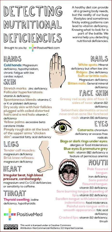 Detecting Vitamin/Nutrient defencies by symptoms Chart Nutrition Sportive, Nutritional Deficiencies, Health Info, Body Health, Health Remedies, Holistic Health, Healthy Body, Healthy Tips, Healthy Habits