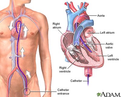 Cath Lab Nursing, Ablation Surgery, Cath Lab Nurse, Heart Catheterization, Enlarged Heart, Radiology Student, Cardiac Disease, Heart Function, Heart Muscle