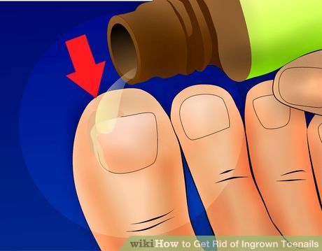 Image titled Get Rid of Ingrown Toenails Step 15 Infected Ingrown Hair, Nail Remedies, Fingernail Fungus, Toenail Fungus Remedies, Nail Problems, Ingrown Toenail, Nail Infection, Ingrown Nail, Fungal Nail