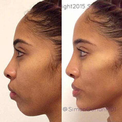 Dr. Simon Ourian - Epione sur Instagram : « Nonsurgical cheek & chin augmentation. Before (left) and after (right) of nonsurgical cheek lift and augmentation plus chin… » Rhinoplasty Recovery, Chin Filler, Cheek Lift, Chin Augmentation, Vicki Gunvalson, Chin Implant, Face Fillers, Hair Implants, Cheek Fillers