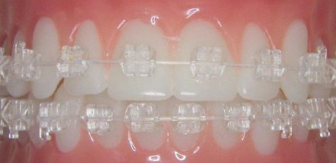 Now this is a cool looking esthetic wire! Simpliclear.com has them. Ceramic Braces, Cute Braces Colors, Types Of Braces, Adult Braces, Cute Braces, Clear Braces, Brace Face, Laser Teeth Whitening, Braces Colors