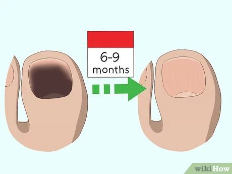 Dark Toe Nails Remedy, Thick Toenail Remedy How To Get Rid, Thick Toenail Remedy, Dark Toenails, Brown Toe Nails, Black Spot On Toenail, White Spots On Toenails, Black Toenail Fungus, Black Toenails